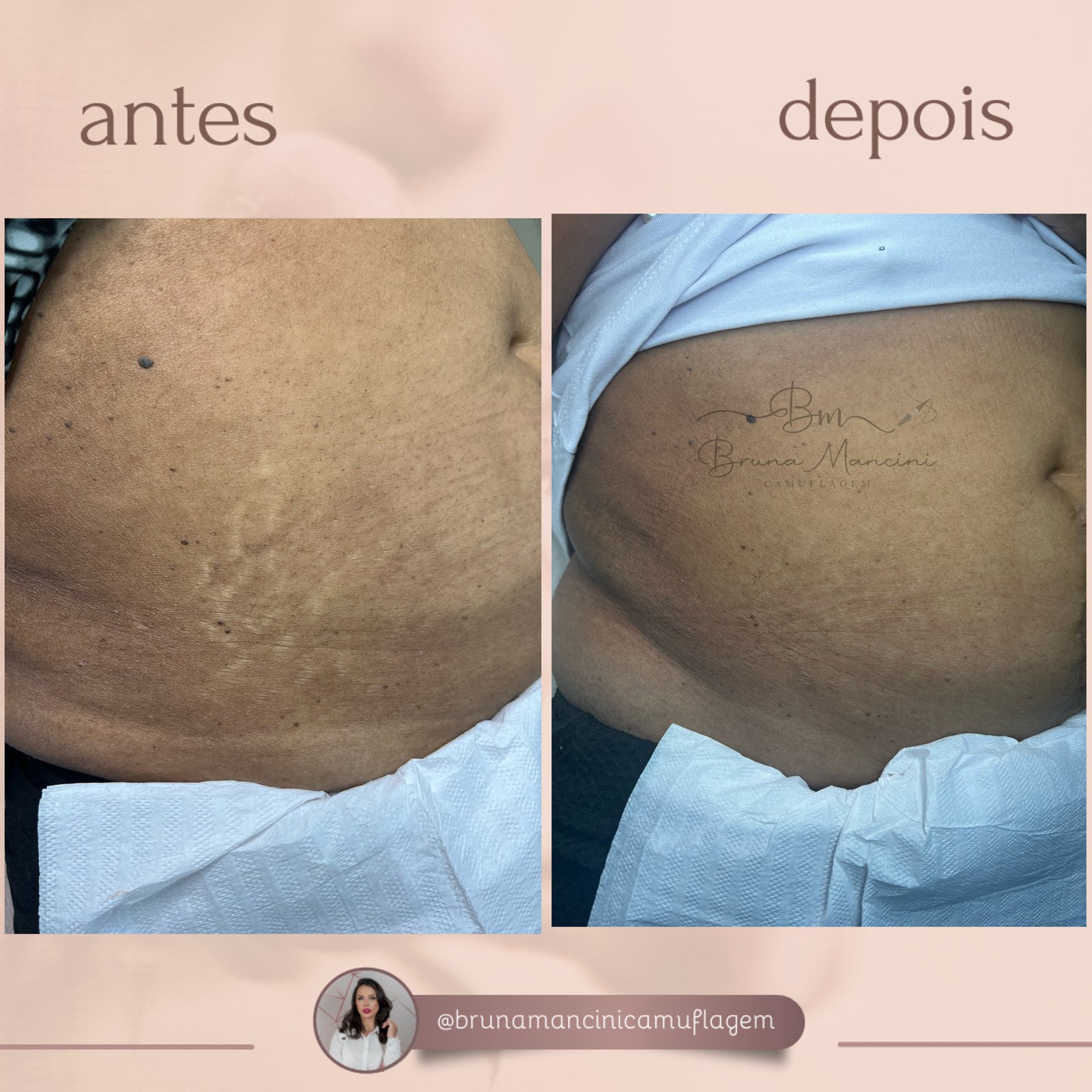 Método Diamond