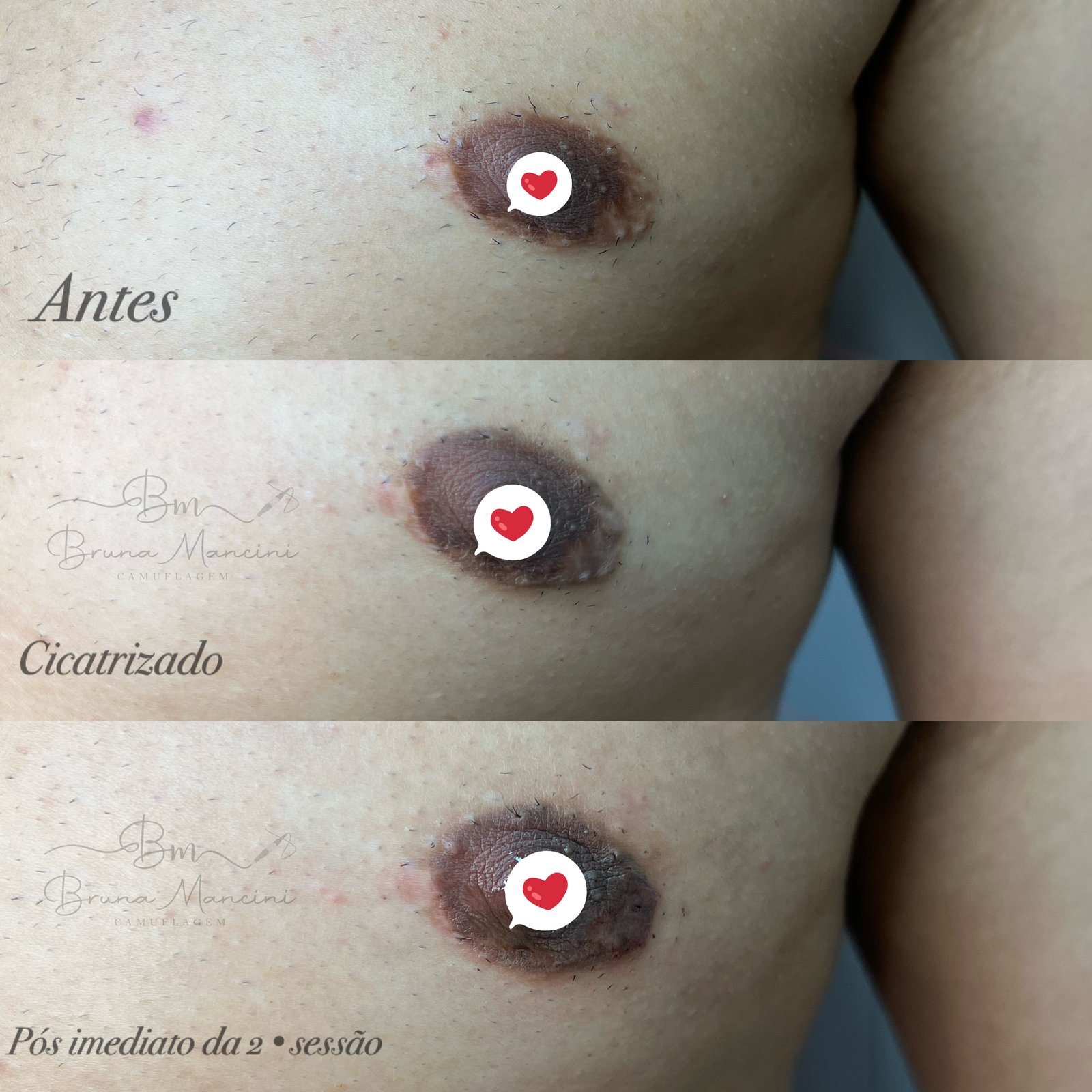 Camuflagem de Cicatriz