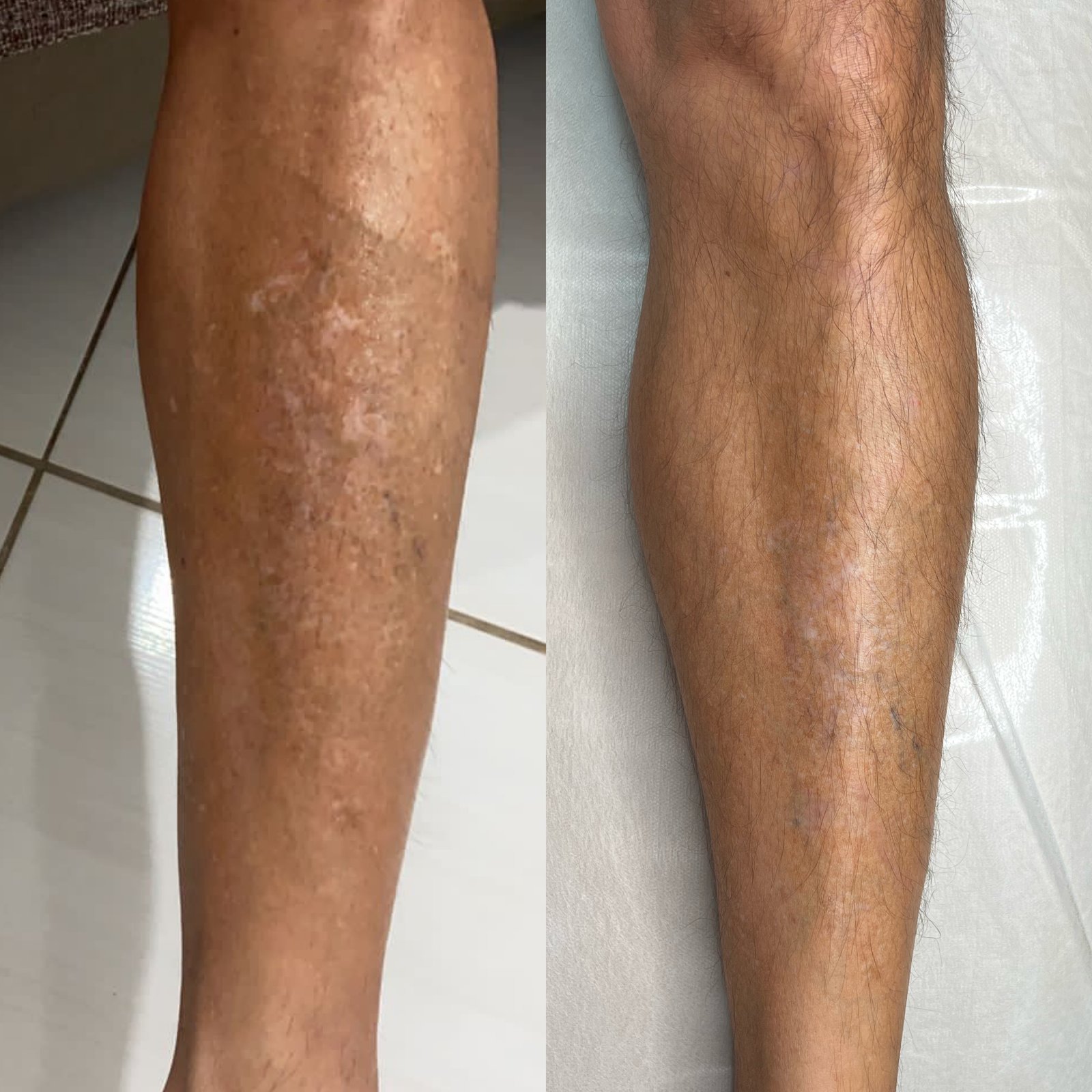 Resultado Natural